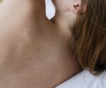 Como evitar las manchas en la piel por el verano