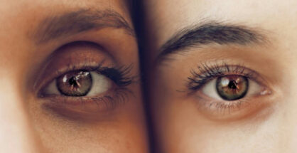 ojeras